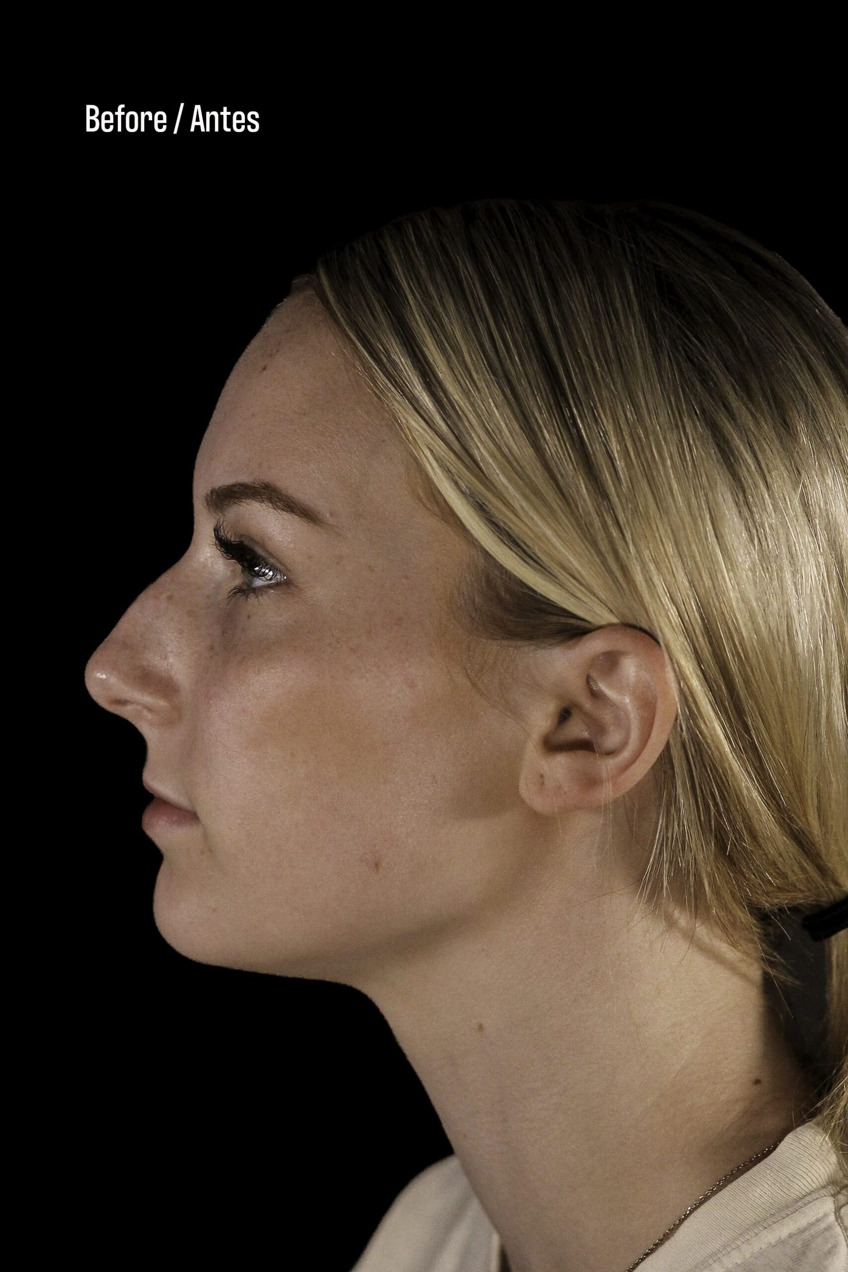 Rhinoplasty Patient Photo - Case 6371 - before view-