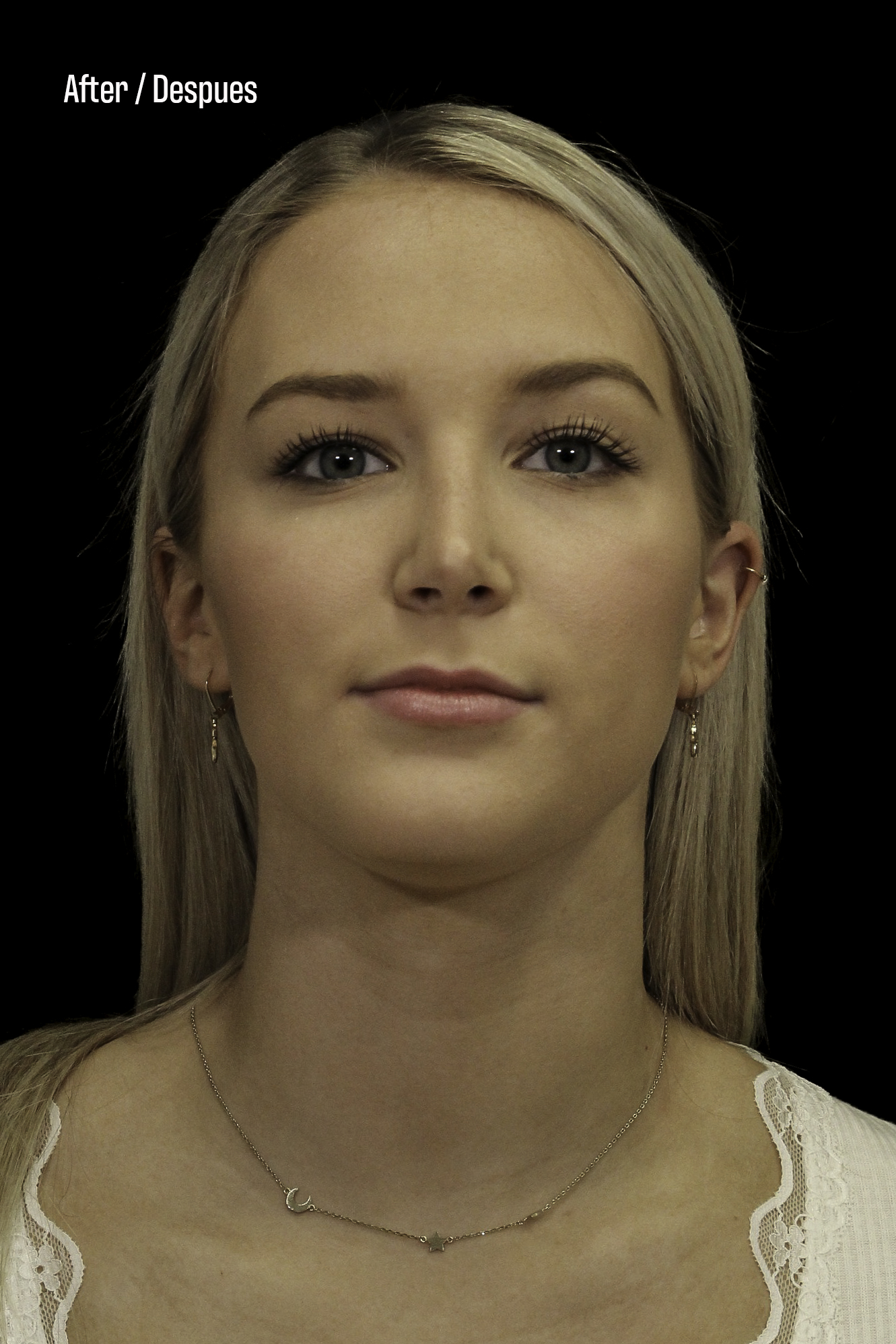 Rhinoplasty Patient Photo - Case 6371 - after view-4