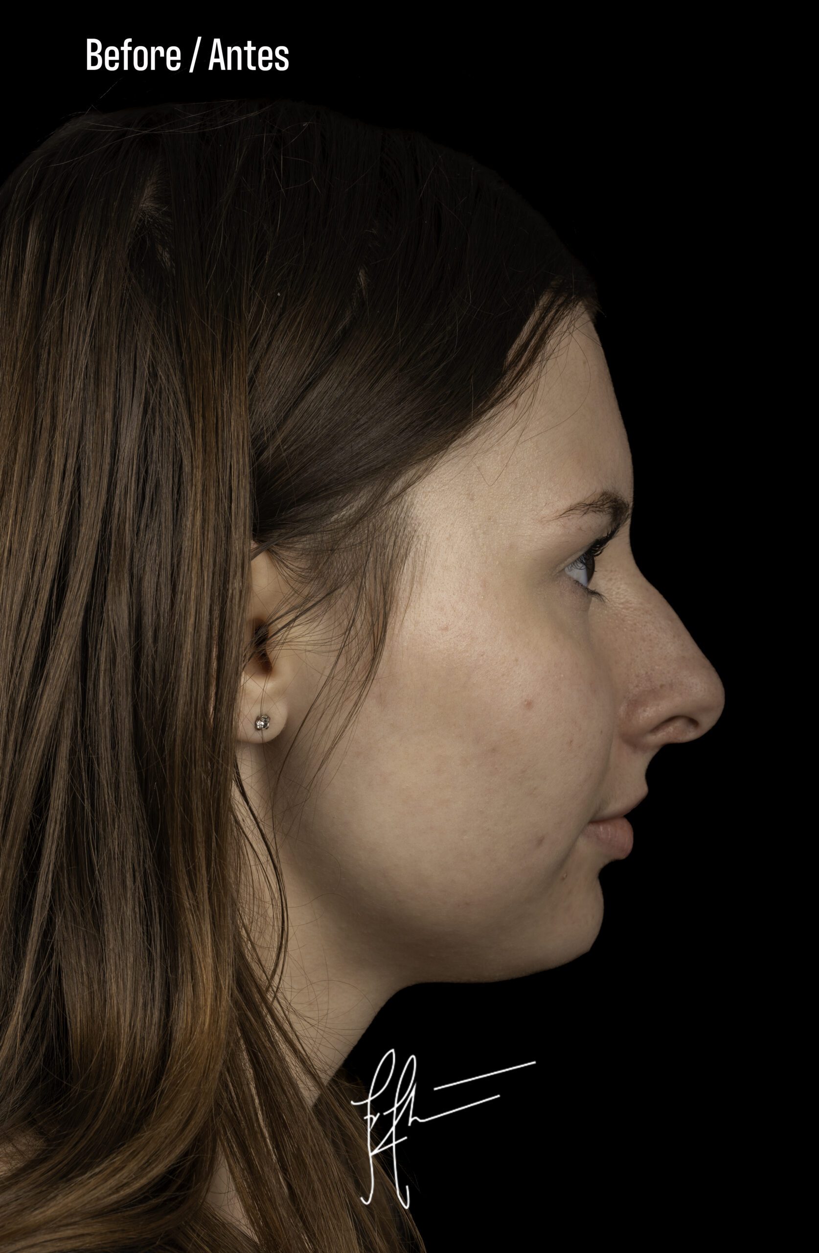 Rhinoplasty Patient Photo - Case 6369 - before view-0