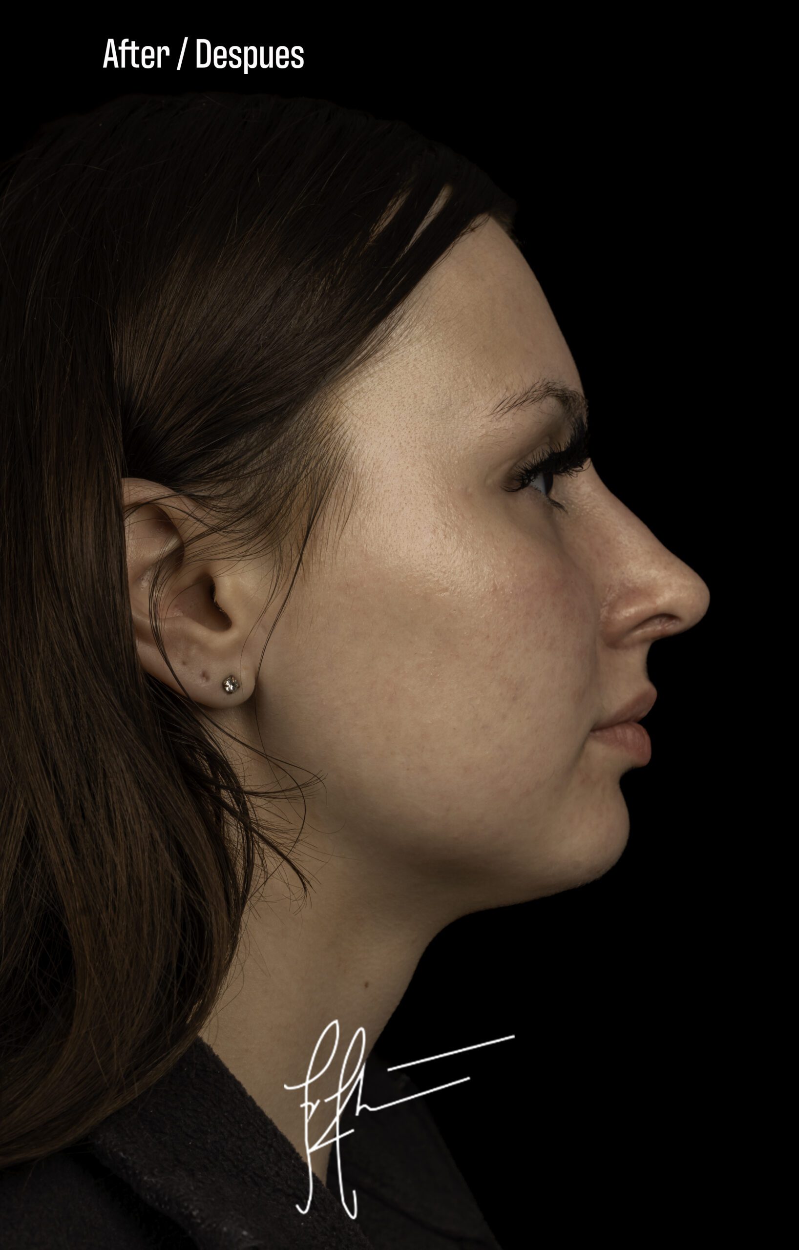 Rhinoplasty Patient Photo - Case 6369 - after view-0