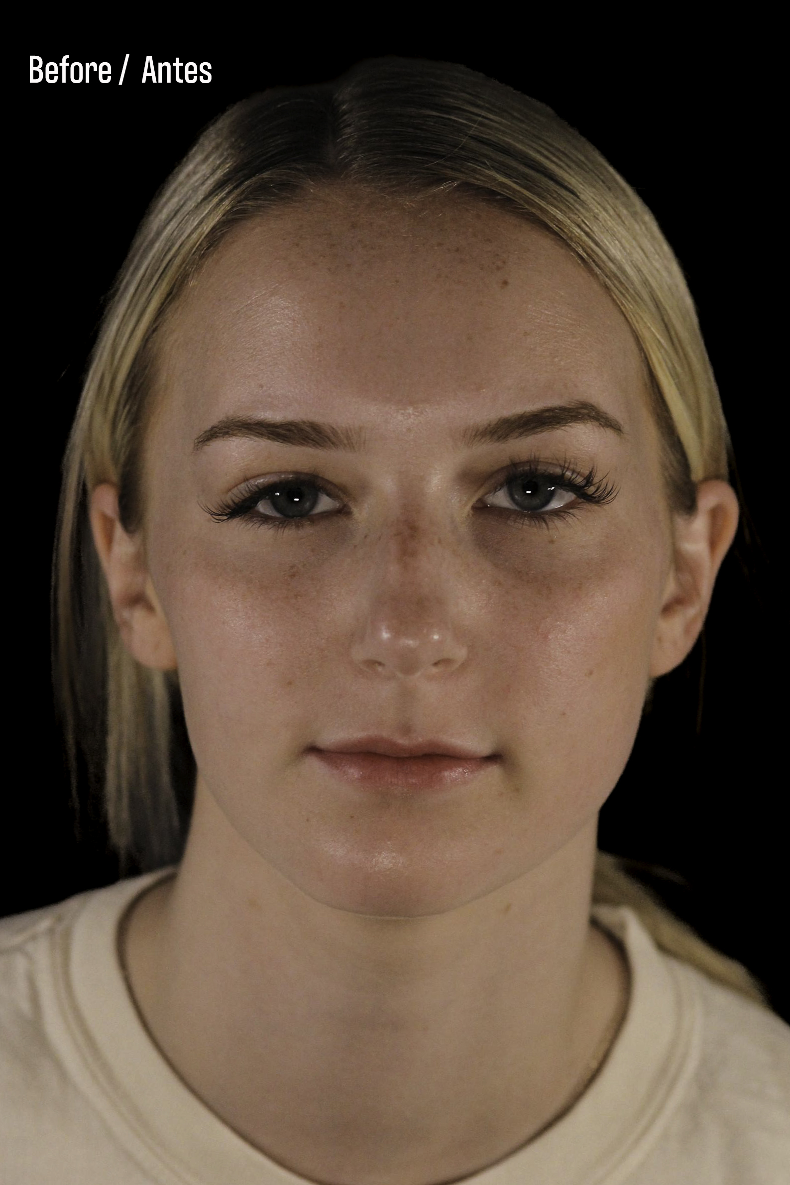 Rhinoplasty Patient Photo - Case 6371 - before view-4