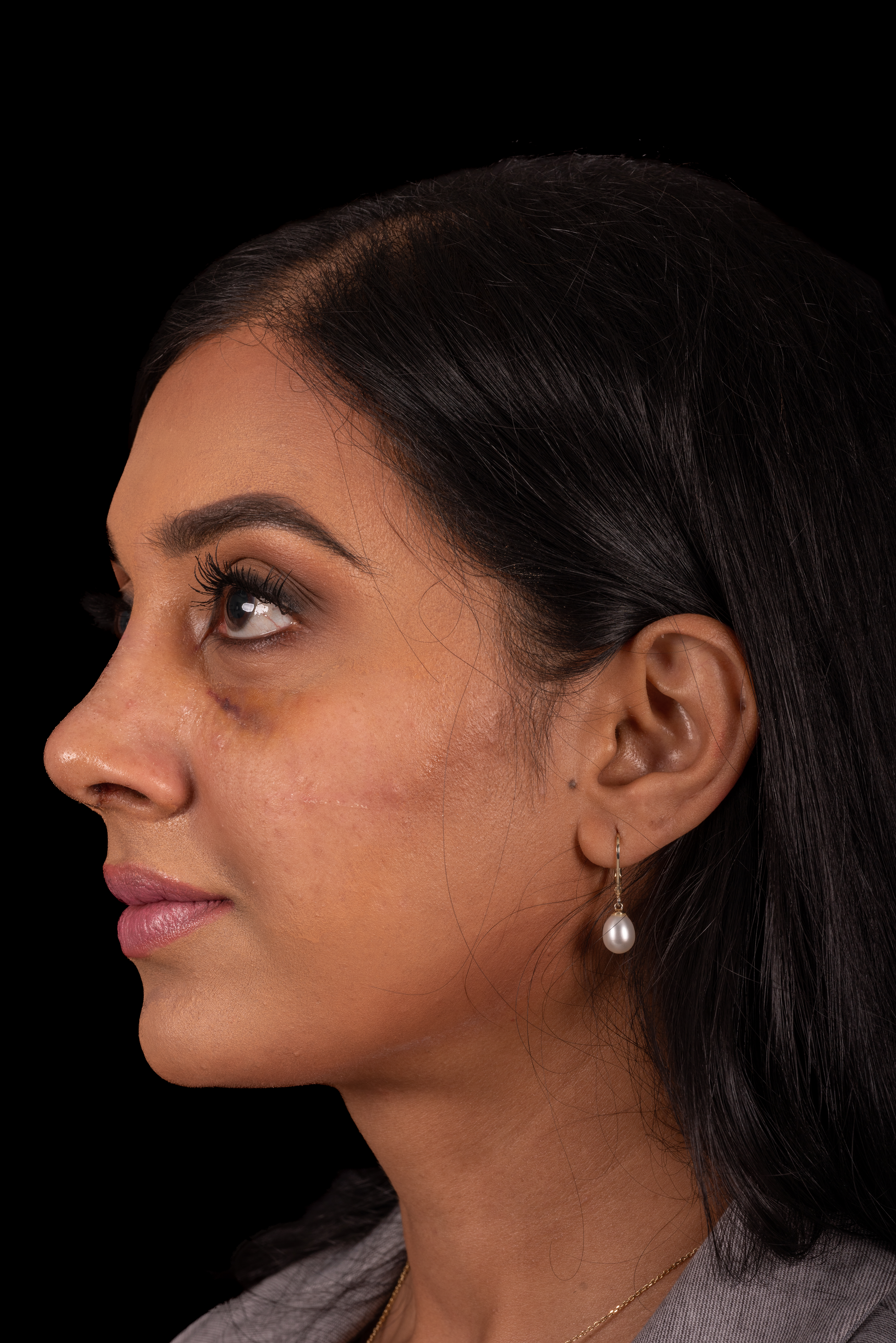 Rhinoplasty Patient Photo - Case 6440 - after view-3