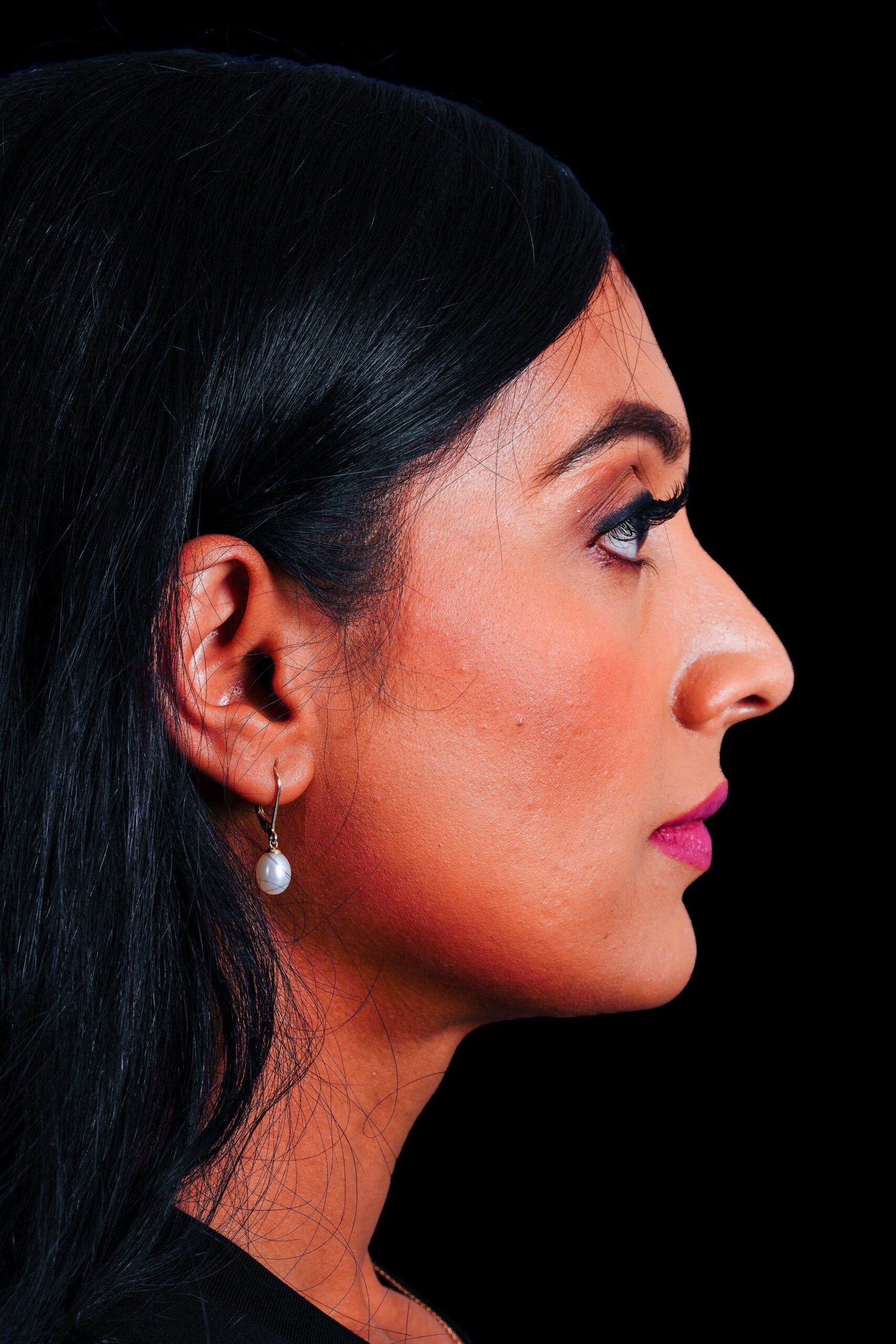 Rhinoplasty Patient Photo - Case 6440 - before view-