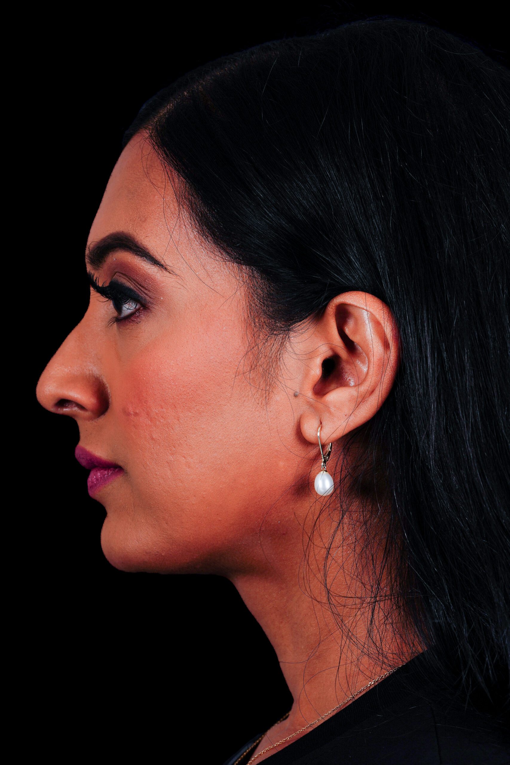 Rhinoplasty Patient Photo - Case 6440 - before view-4