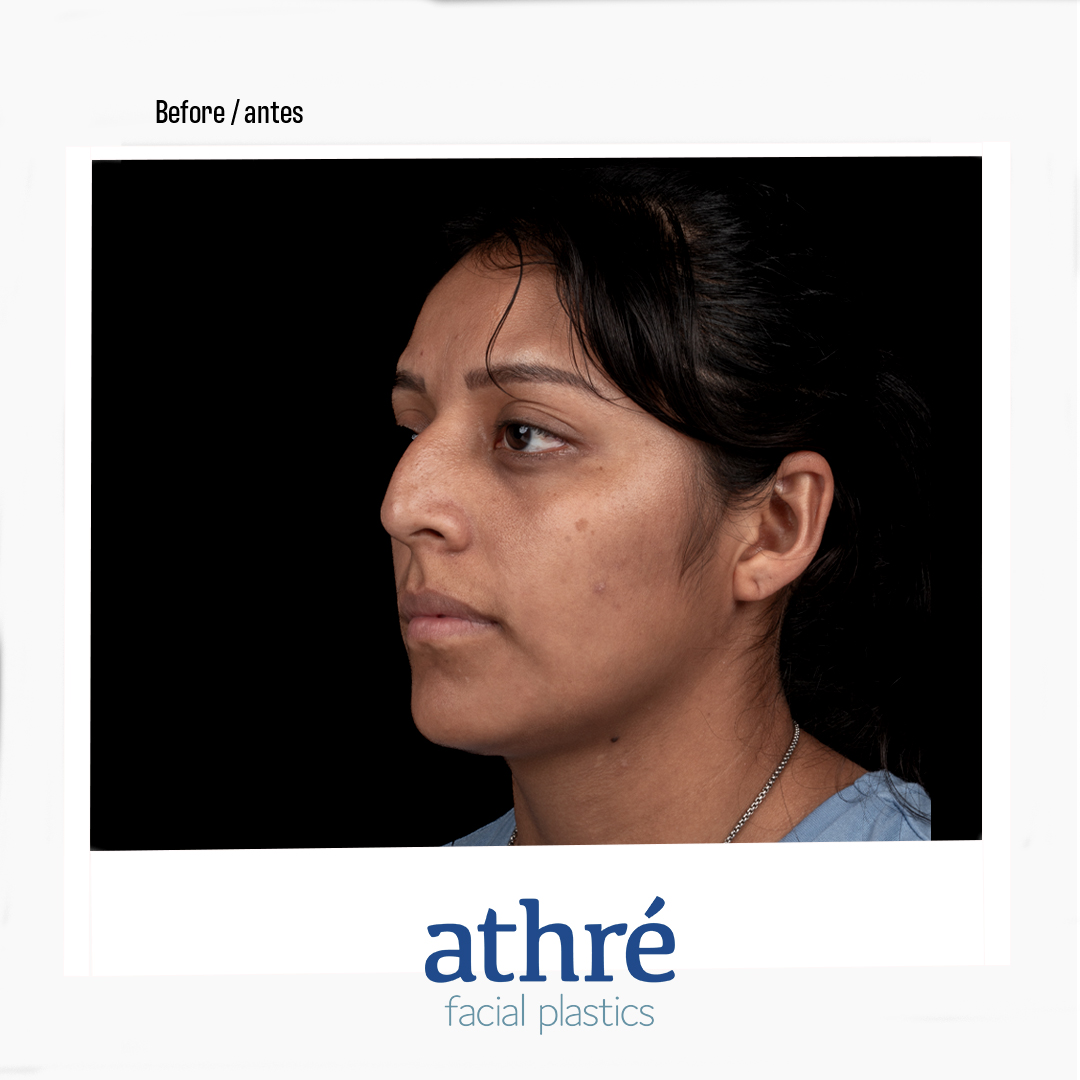 Rhinoplasty Patient Photo - Case 7016 - before view-3