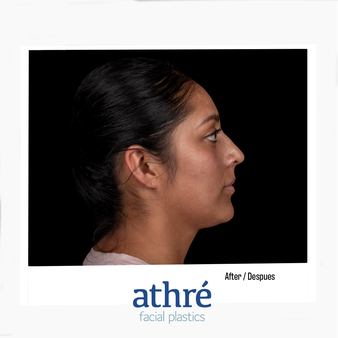 Rhinoplasty Patient Photo - Case 7016 - after view-2