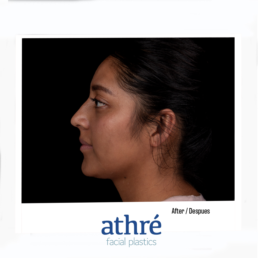Rhinoplasty Patient Photo - Case 7016 - after view-4