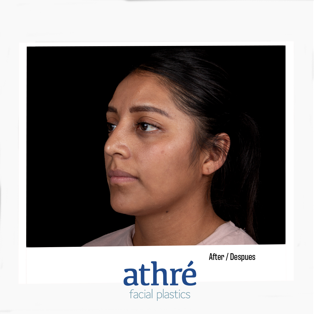 Rhinoplasty Patient Photo - Case 7016 - after view-3