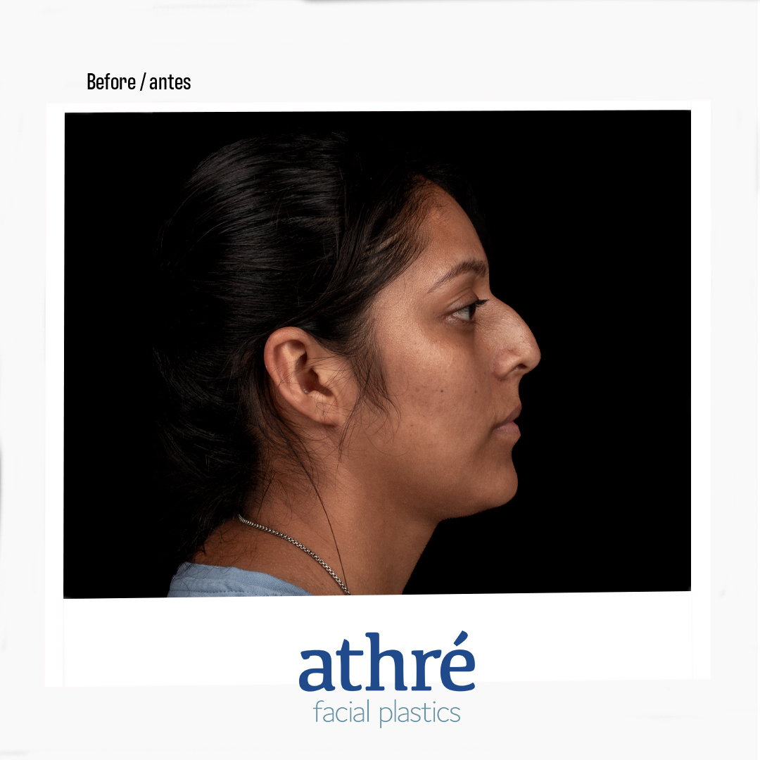 Rhinoplasty Patient Photo - Case 7016 - before view-2