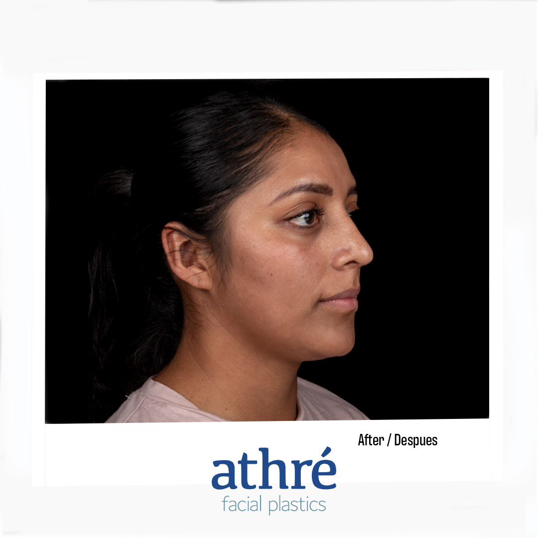 Rhinoplasty Patient Photo - Case 7016 - after view-1