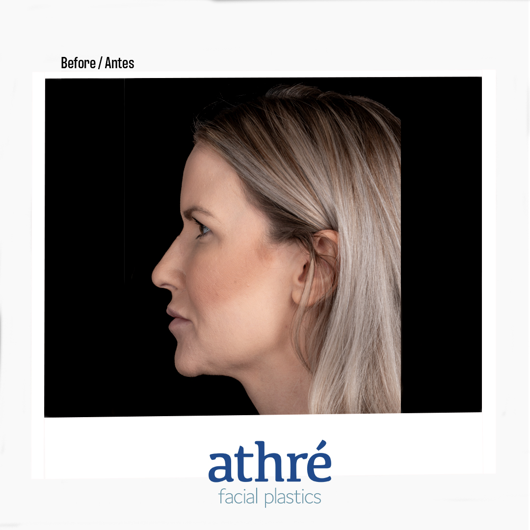 Revision Rhinoplasty Patient Photo - Case 7040 - before view-4