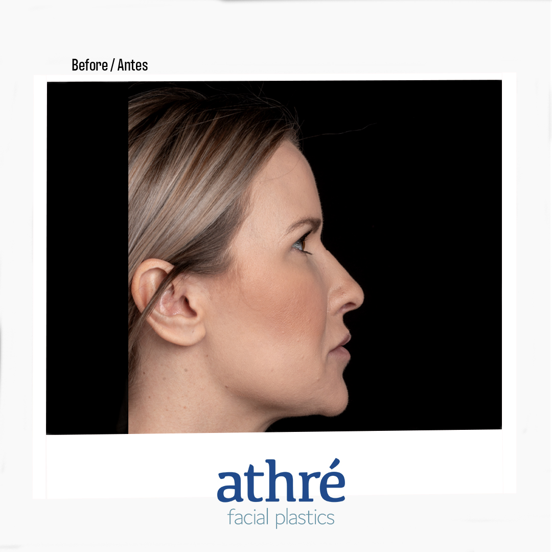 Revision Rhinoplasty Patient Photo - Case 7040 - before view-2