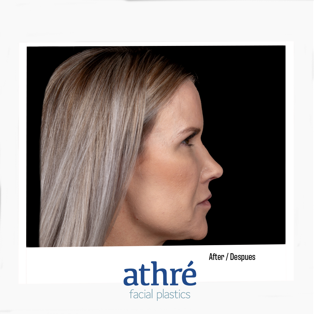 Revision Rhinoplasty Patient Photo - Case 7040 - after view-2