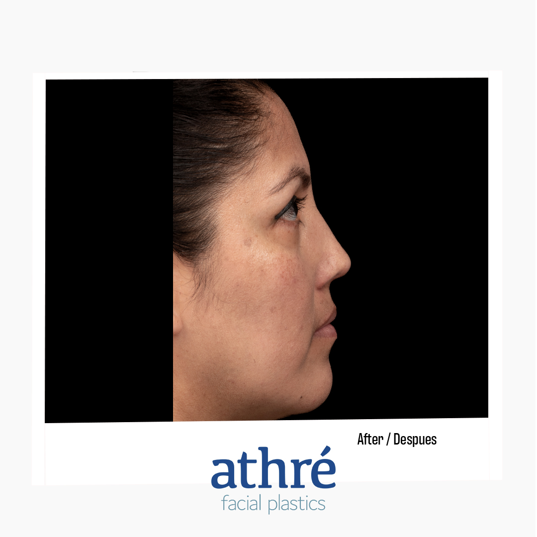 Rhinoplasty Patient Photo - Case 7085 - after view-2
