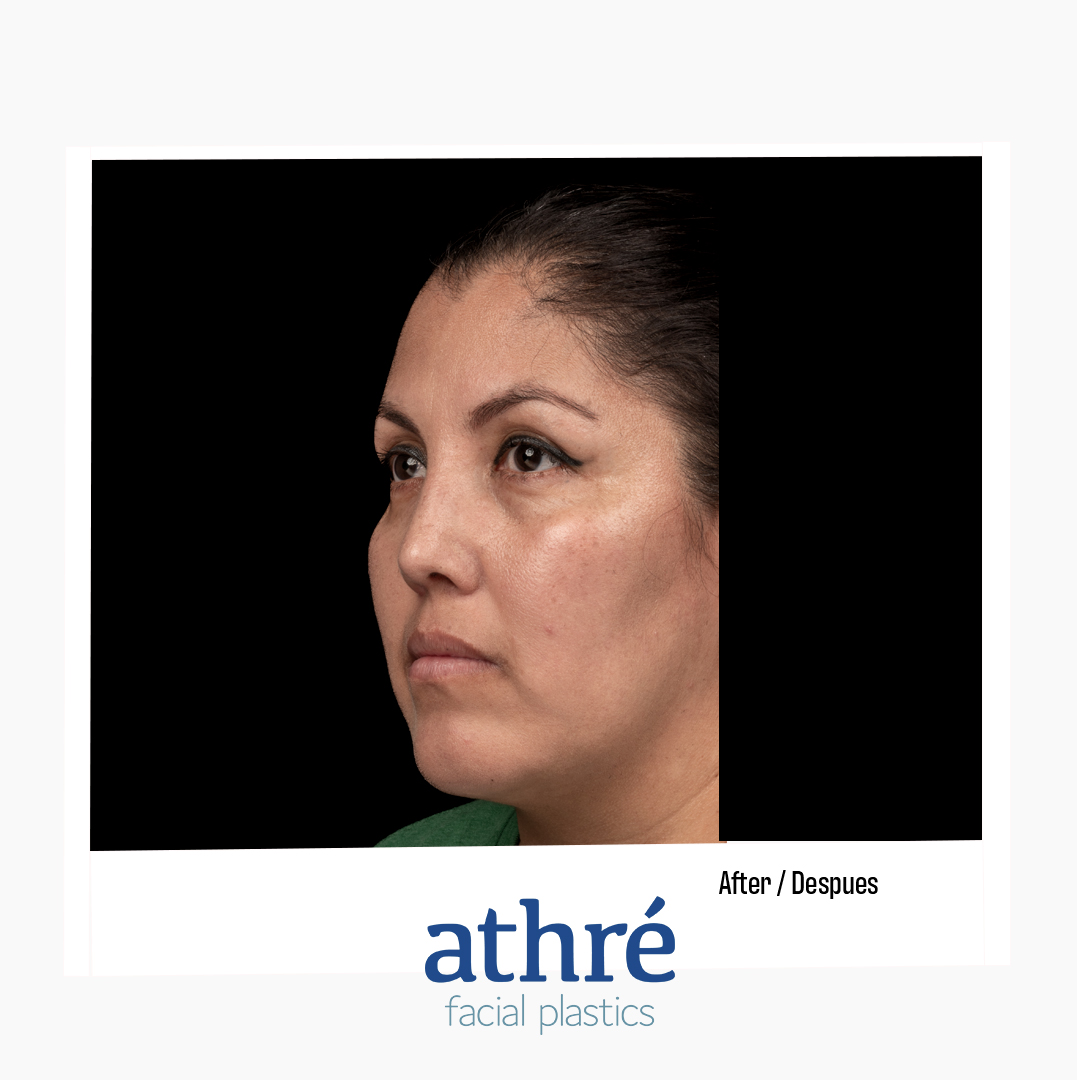 Rhinoplasty Patient Photo - Case 7085 - after view-3