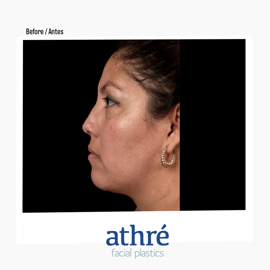 Rhinoplasty Patient Photo - Case 7085 - before view-4