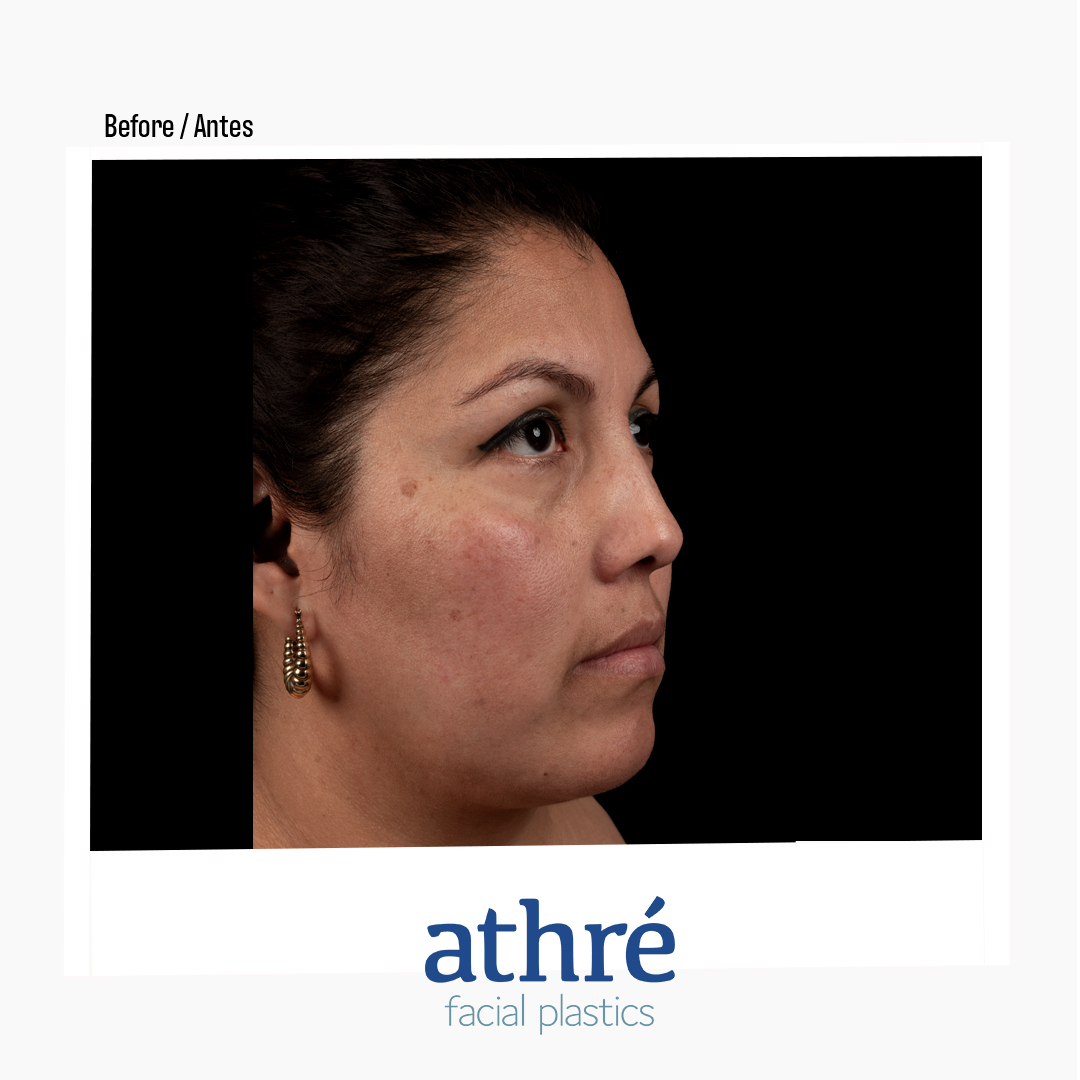 Rhinoplasty Patient Photo - Case 7085 - before view-1