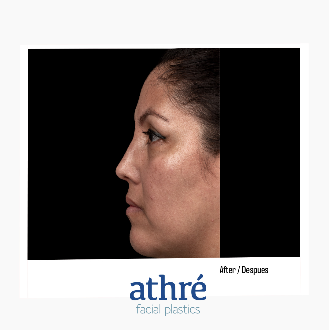 Rhinoplasty Patient Photo - Case 7085 - after view-4
