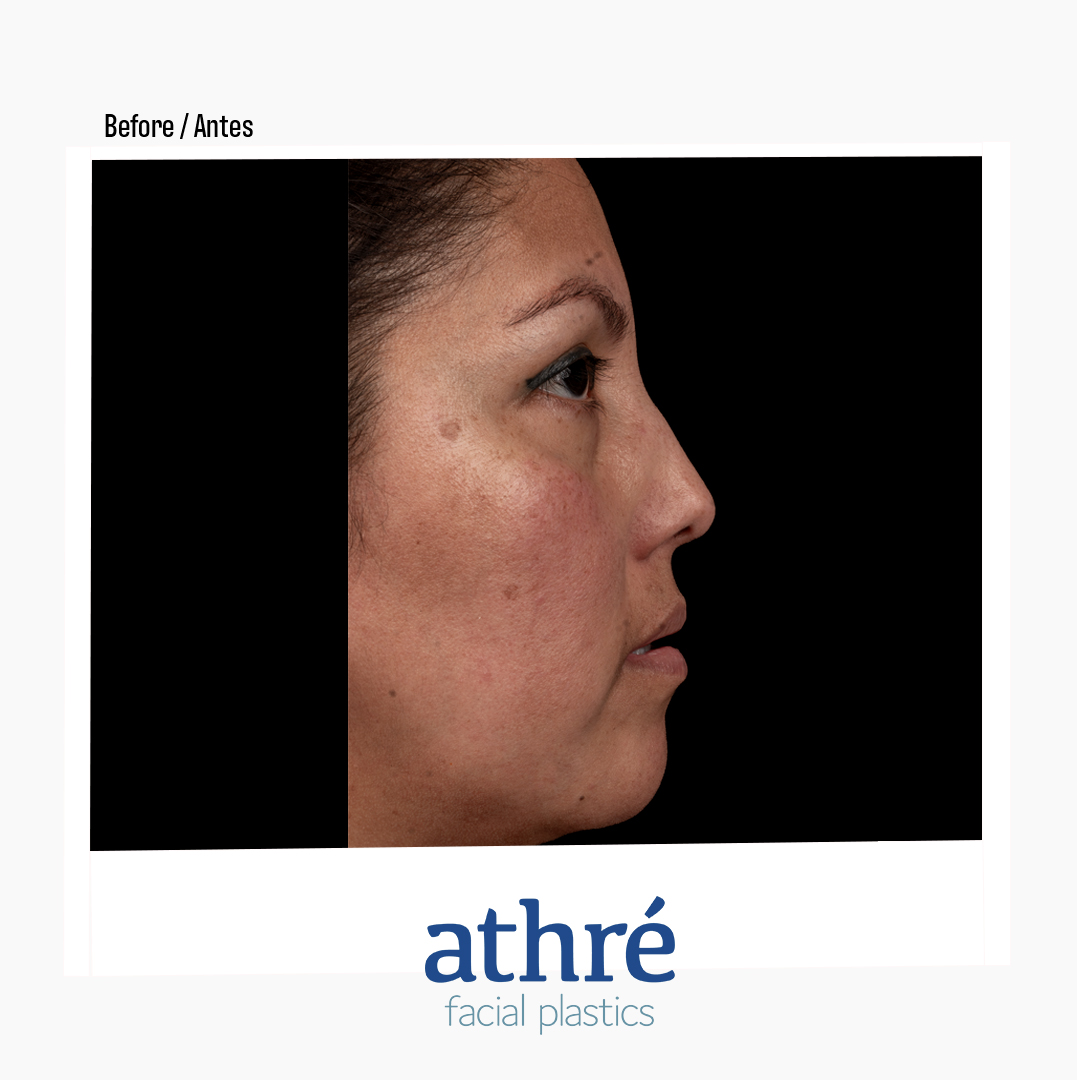Rhinoplasty Patient Photo - Case 7085 - before view-2