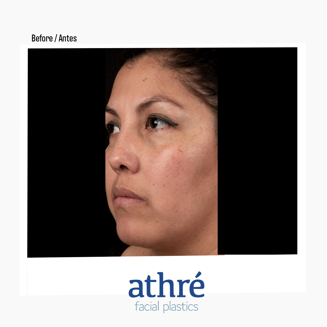Rhinoplasty Patient Photo - Case 7085 - before view-3