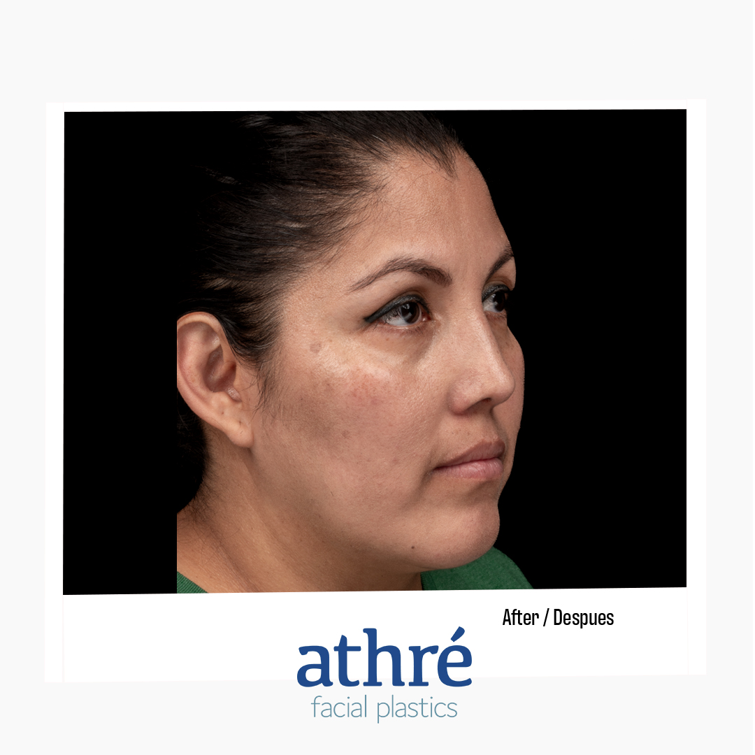Rhinoplasty Patient Photo - Case 7085 - after view-1