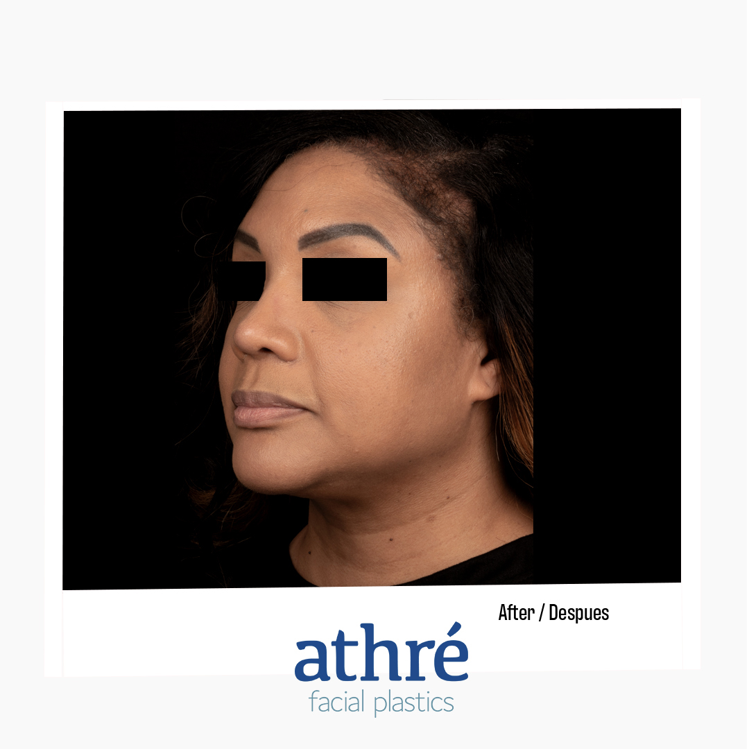 Rhinoplasty Patient Photo - Case 7110 - after view-3
