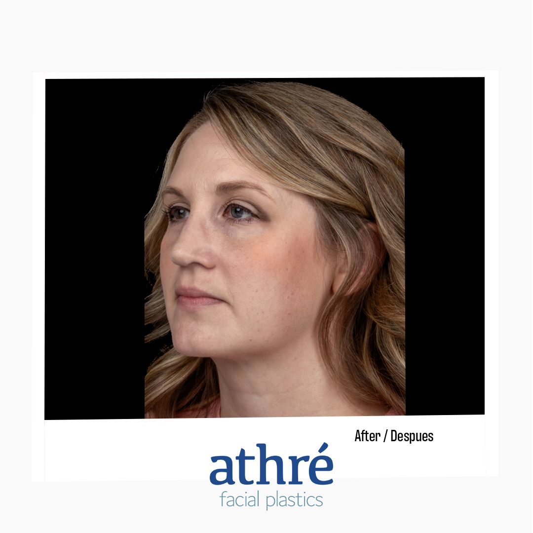 Revision Rhinoplasty Patient Photo - Case 7172 - before view-2
