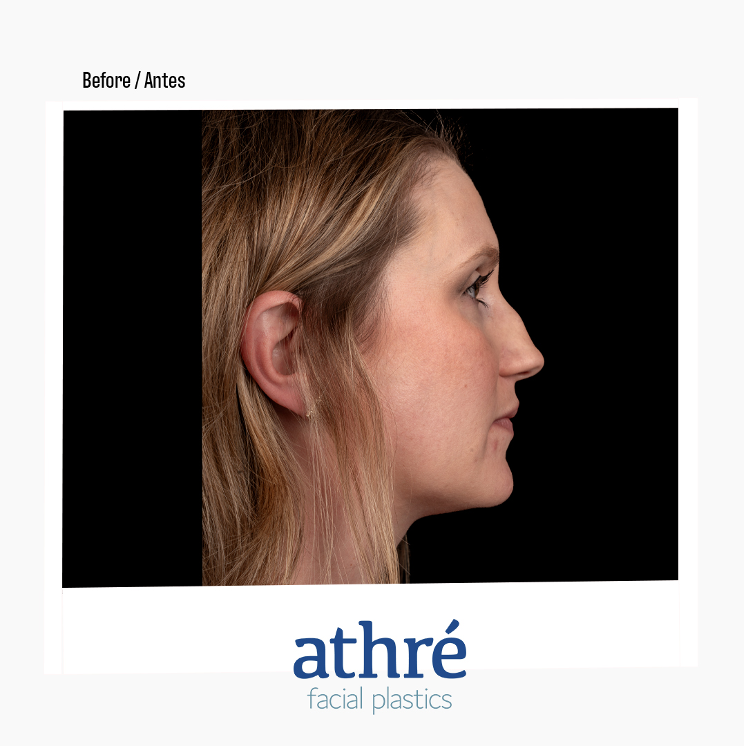 Revision Rhinoplasty Patient Photo - Case 7172 - after view-3