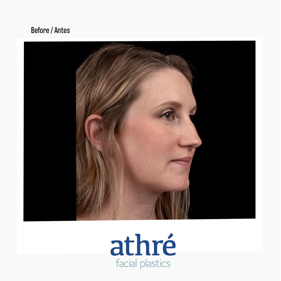 Revision Rhinoplasty Patient Photo - Case 7172 - after view-4