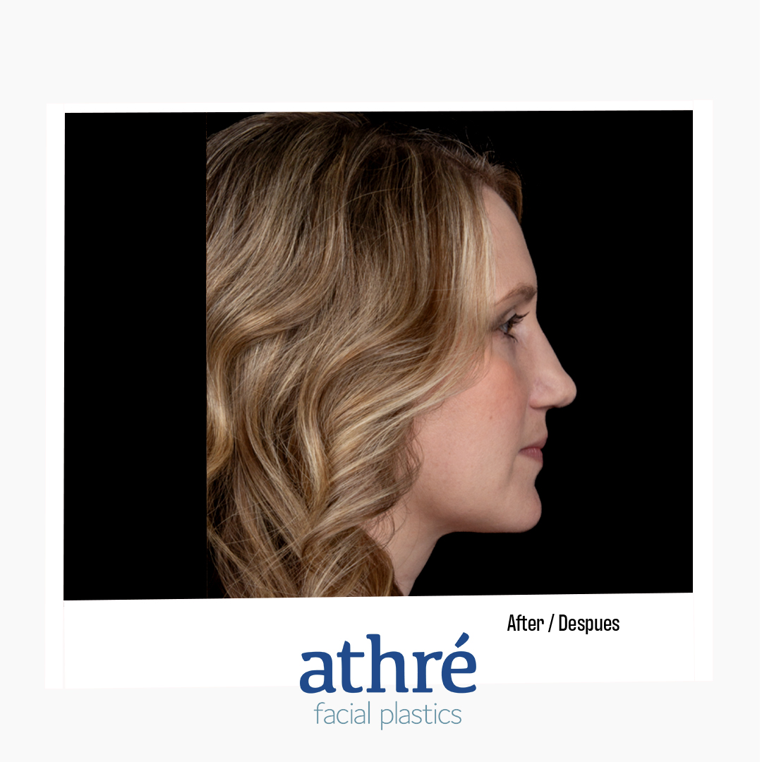Revision Rhinoplasty Patient Photo - Case 7172 - before view-3