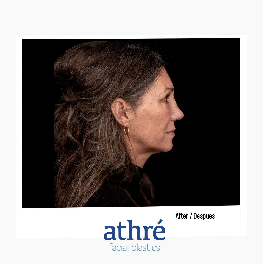 Revision Rhinoplasty Patient Photo - Case 7471 - after view-4