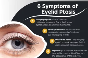 6 Symptoms of Eyelid Ptosis