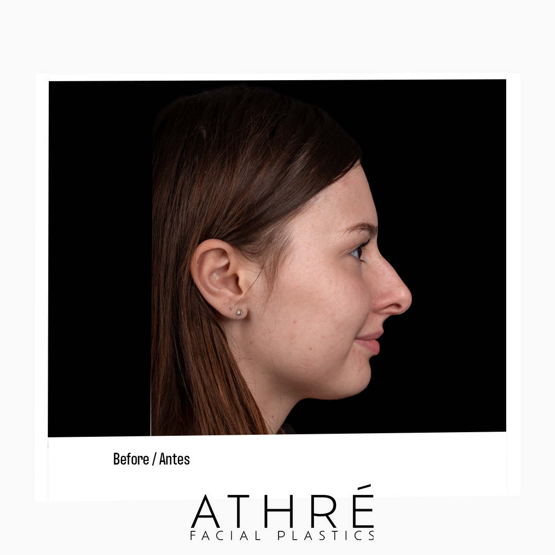 Rhinoplasty Patient Photo - Case 7673 - before view-2