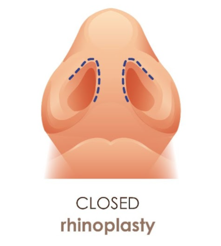 closed-rhinoplasty