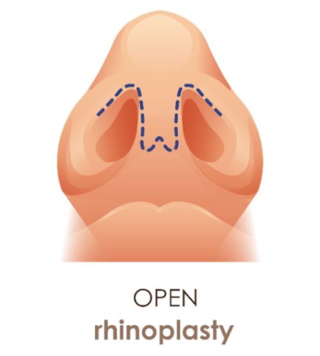 open-rhinoplasty