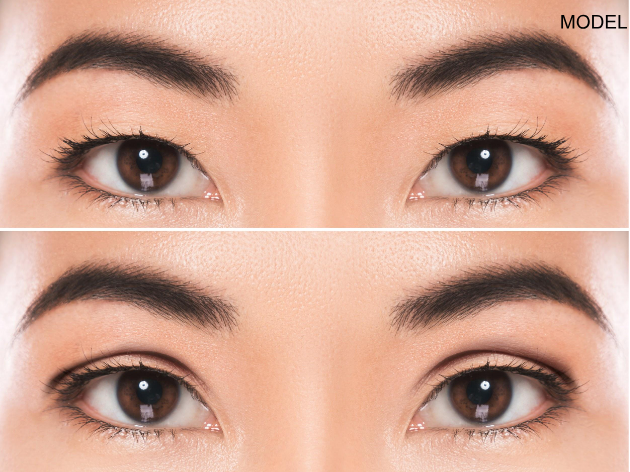 Asian eyelid surgery 2