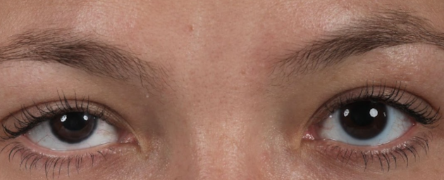 eyelid ptosis