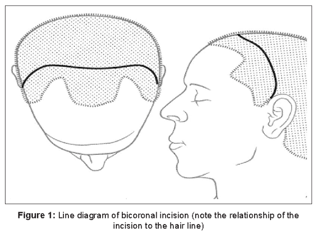 bicoronal brow lift diagram